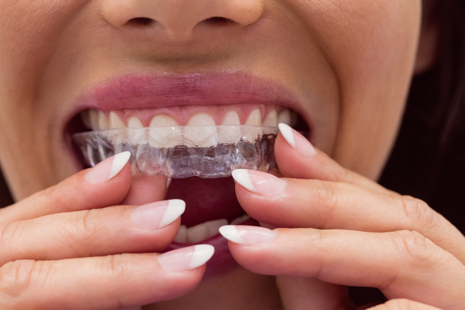 Donna che indossa un allineatore trasparente sui denti superiori
