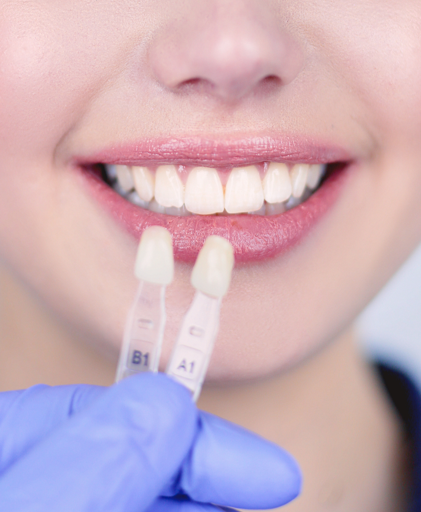 Faccette Dentali Roma Eur Laurentina