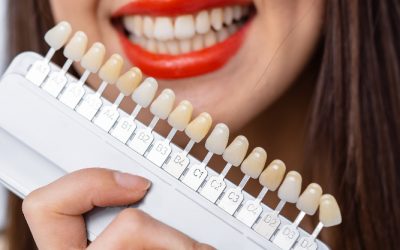 Perché le Faccette Dentali sono così apprezzate?